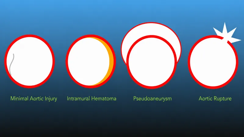 Diagram of traumatic aortic injury types