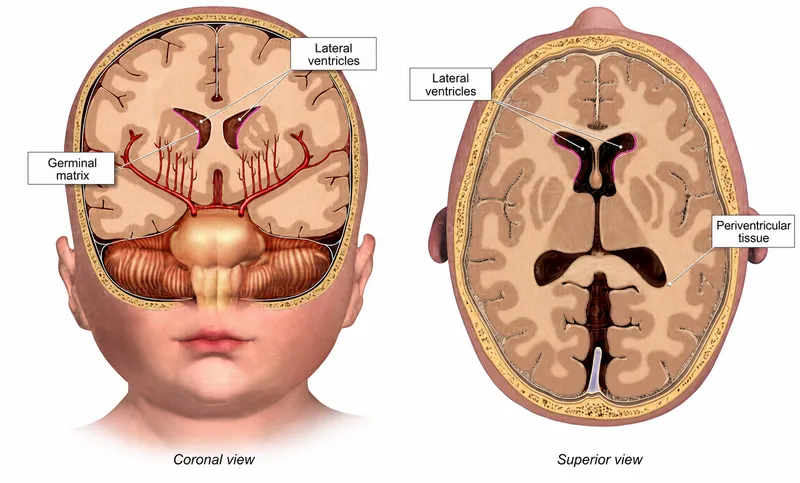 Neonatal Brain: Germinal Matrix & Lateral Ventricles