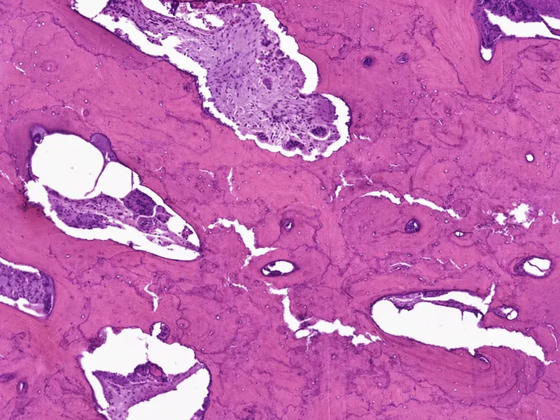Bone biopsy showing mosaic pattern characteristic of Paget's disease