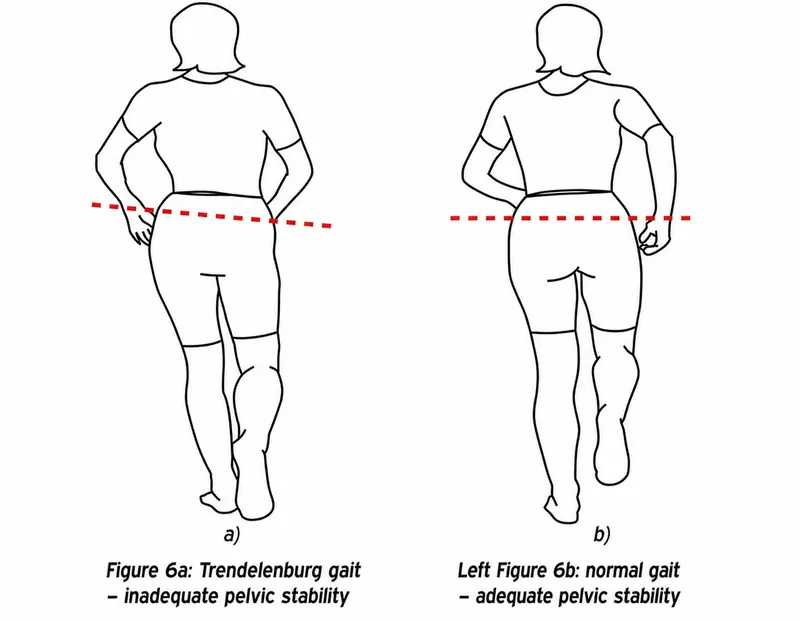 Trendelenburg vs Normal Gait: Pelvic Stability