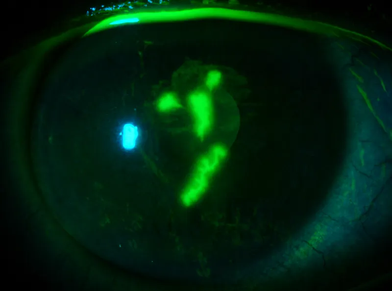 HSV keratitis dendritic ulcer fluorescein stain