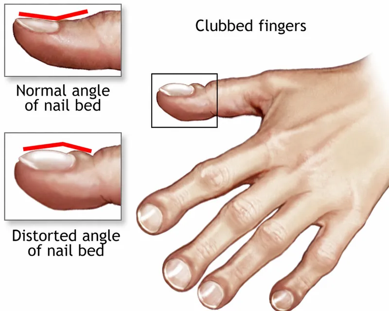 Digital clubbing in cystic fibrosis