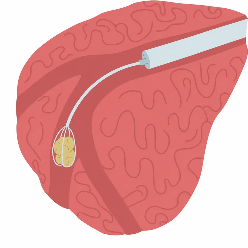 Sialendoscopic view of salivary duct with stone removal procedure