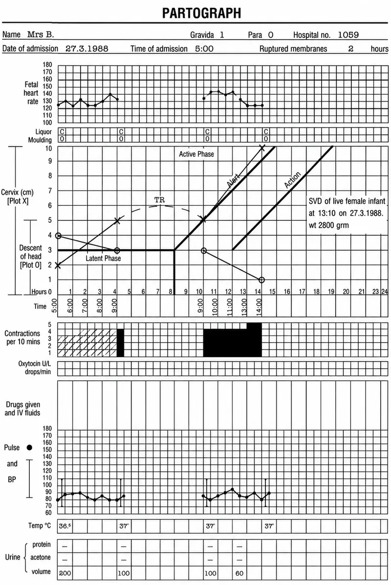 Partograph showing labor progress
