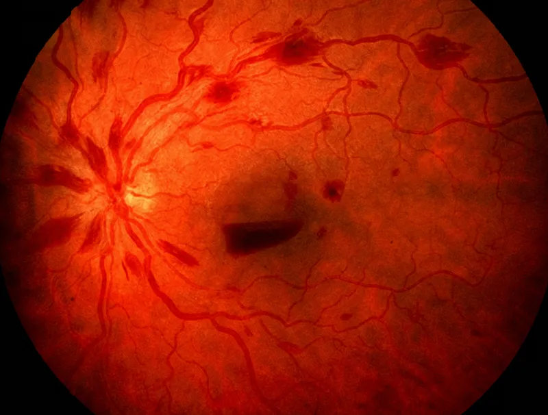 Retinal hemorrhages in thrombocytopenia