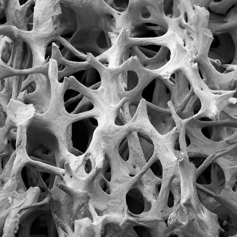 Micrograph of osteoporotic bone