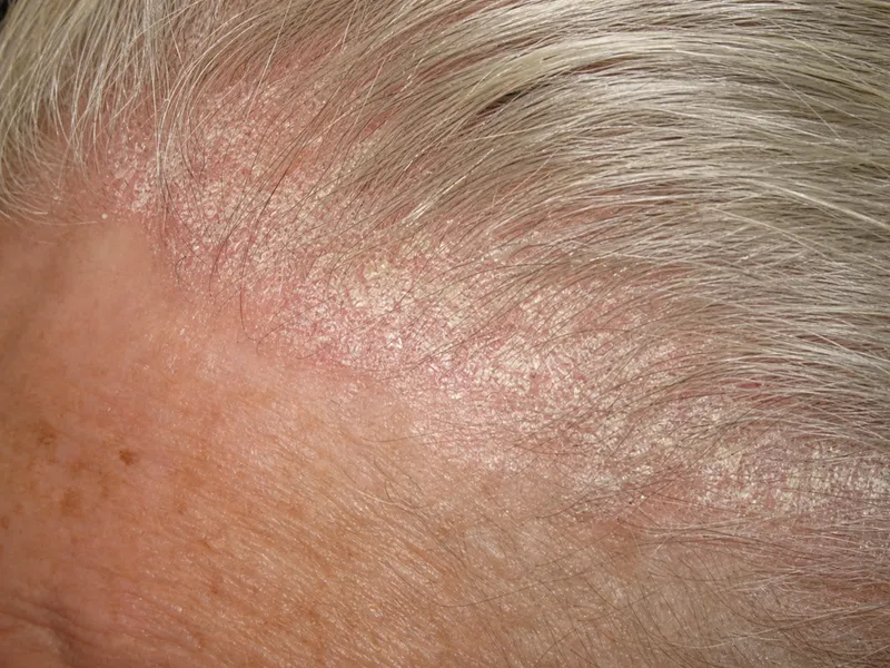 Scalp psoriasis showing thick adherent scales extending beyond hairline