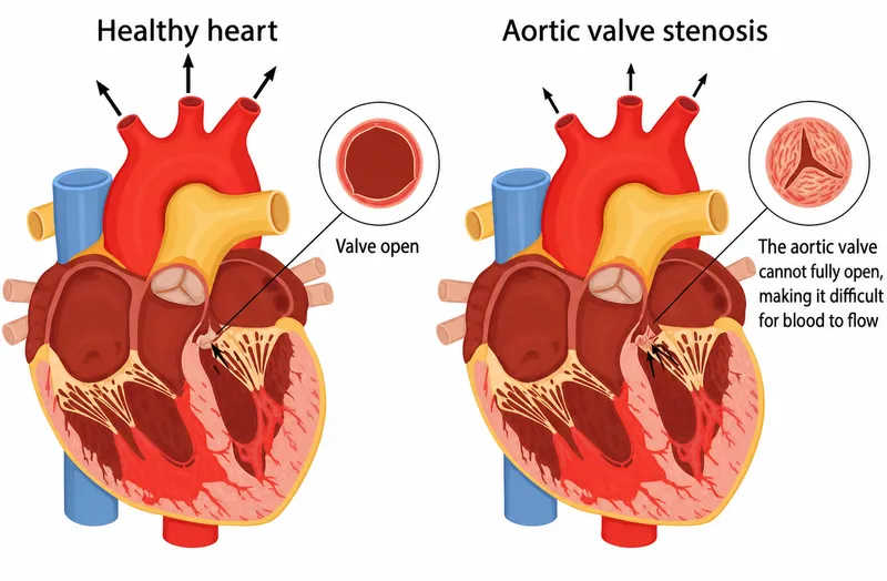 Aortic valve stenosis vs. healthy valve