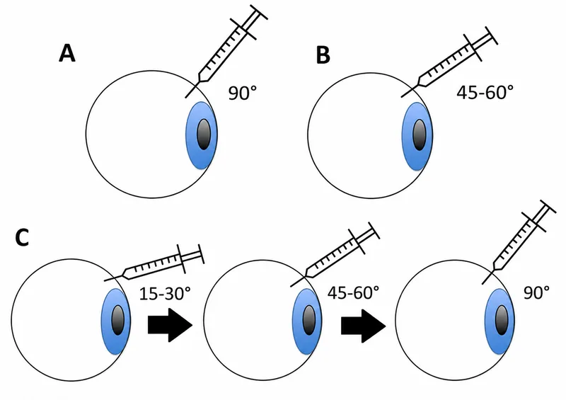 Intravitreal injection needle angles