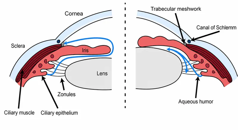Normal vs. Angle-Closure Glaucoma Eye Anatomy