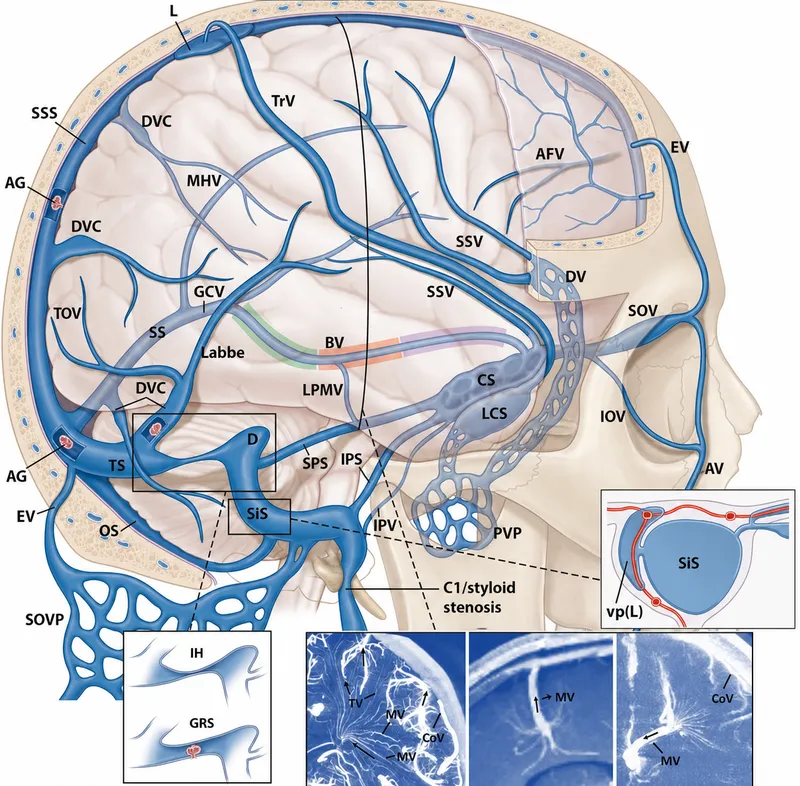Dural venous sinuses and cavernous sinus drainage