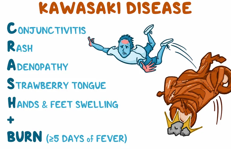 Kawasaki Disease: CRASH + BURN mnemonic