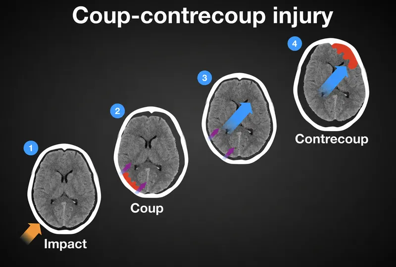 Coup-contrecoup injury mechanism diagram