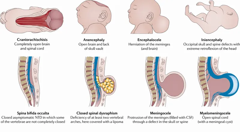 Types of Neural Tube Defects