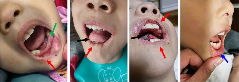 Oral self-mutilation in Lesch-Nyhan syndrome