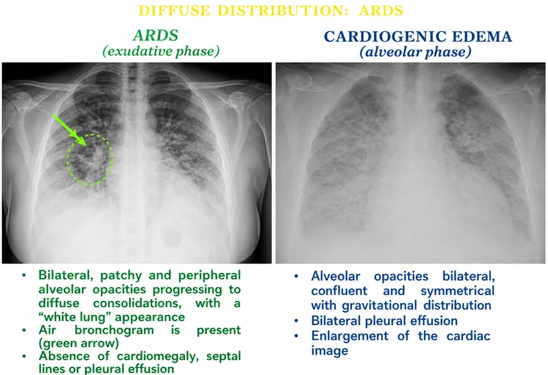 Chest X-ray: ARDS vs. Cardiogenic Edema