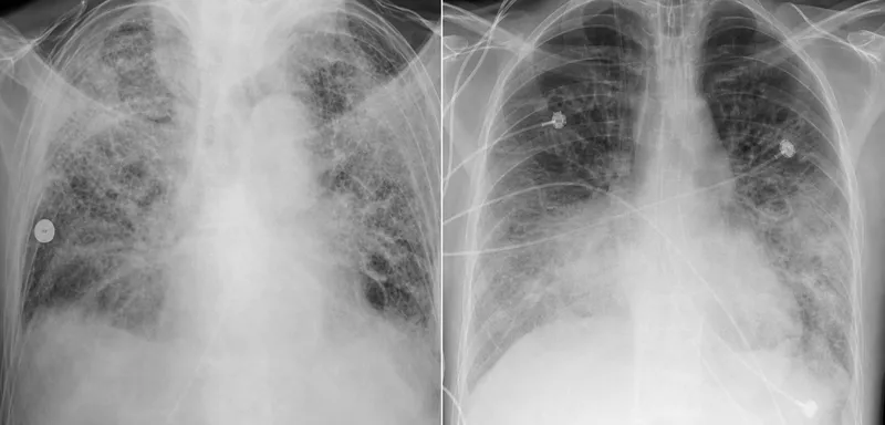 Chest X-ray showing bilateral infiltrates in ARDS