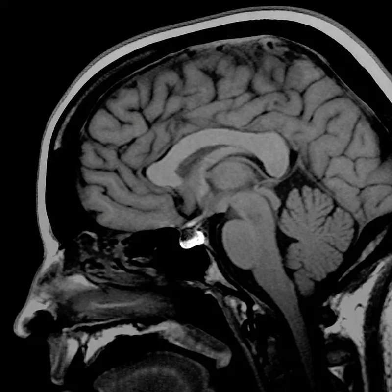 Sagittal MRI of Pituitary Gland Anatomy