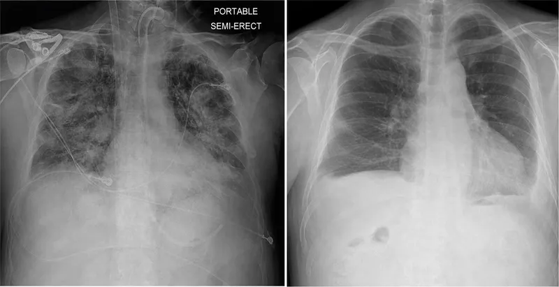 Chest X-ray: Pre- and post-lung transplant