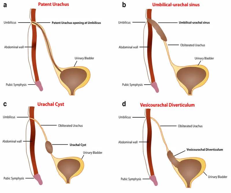 Urachal anomalies: patent urachus, sinus, cyst, diverticulum