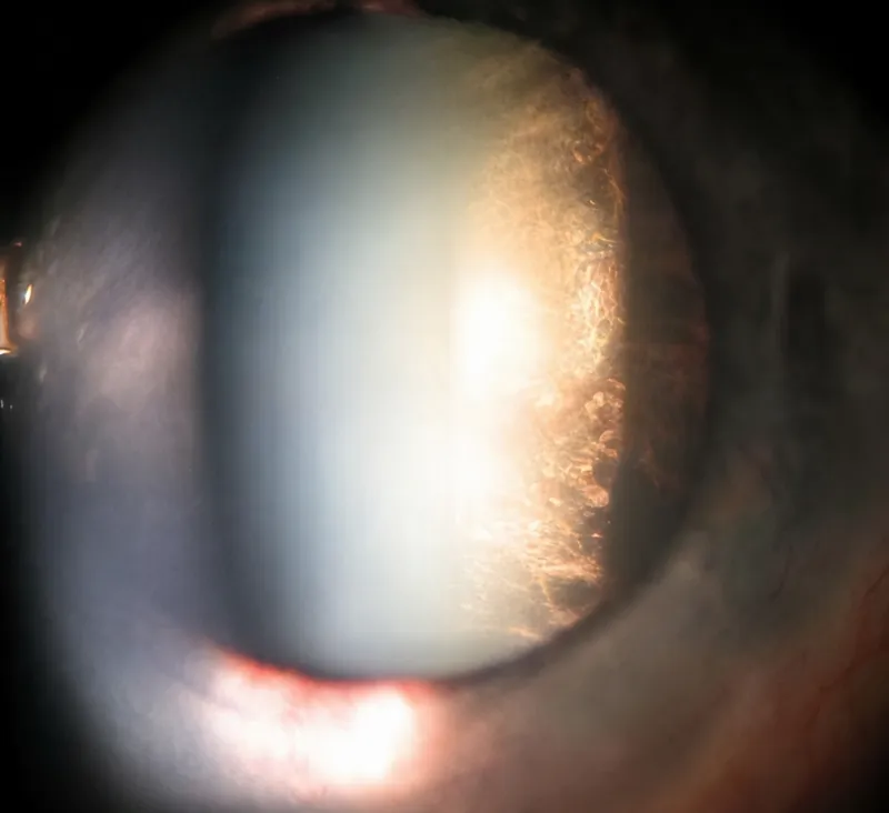Posterior subcapsular cataract