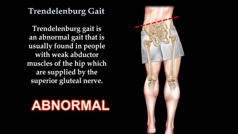 Trendelenburg Gait Illustration