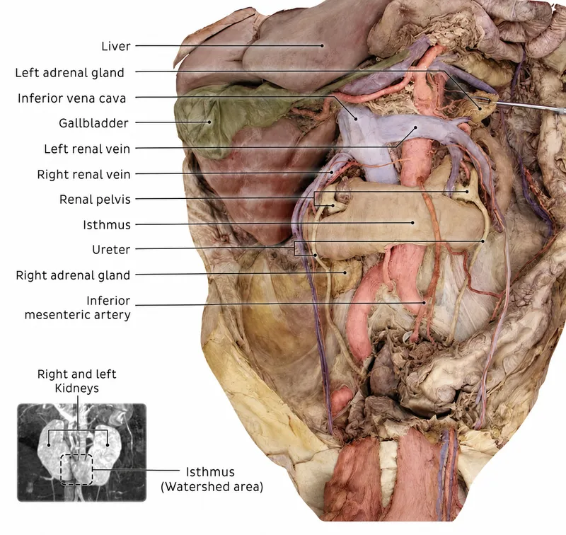 Horseshoe Kidney Anatomy with Isthmus and Great Vessels