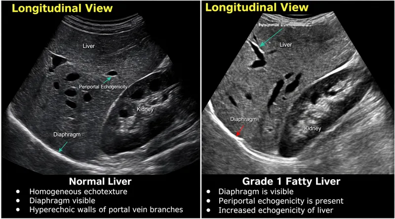 Ultrasound: Normal vs. Grade 1 Fatty Liver