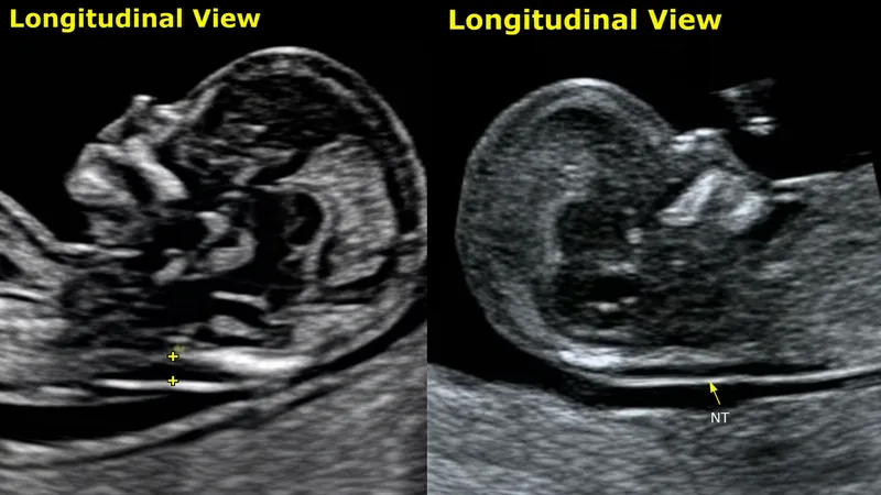 Fetal Nuchal Translucency Ultrasound Measurement