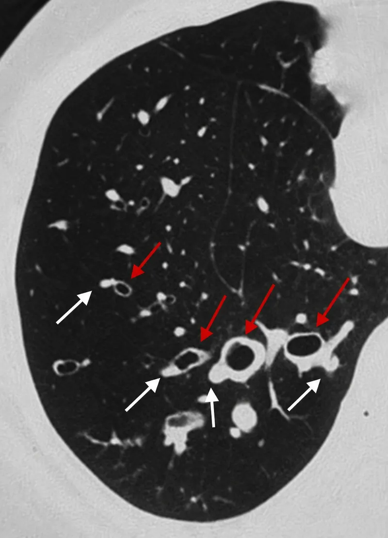HRCT chest: Bronchiectasis signet ring and tram-track signs