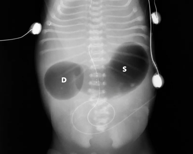 Double bubble sign in duodenal atresia