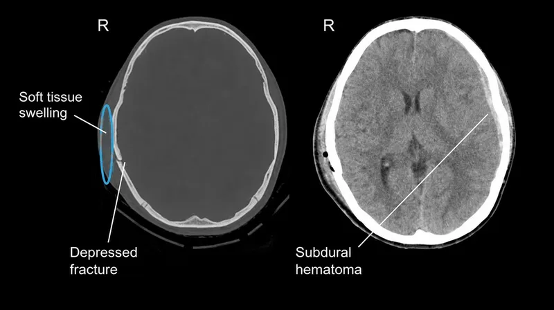 CT: Depressed skull fracture & subdural hematoma