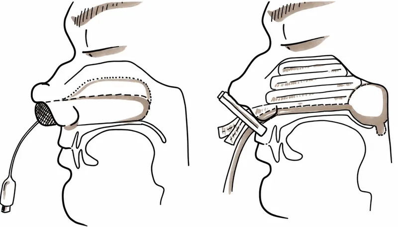 Anterior and posterior nasal packing for epistaxis