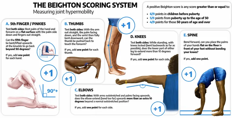 Beighton Scoring System for Joint Hypermobility
