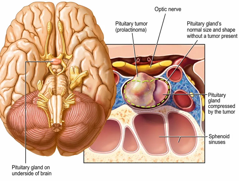 Prolactinoma compressing pituitary gland