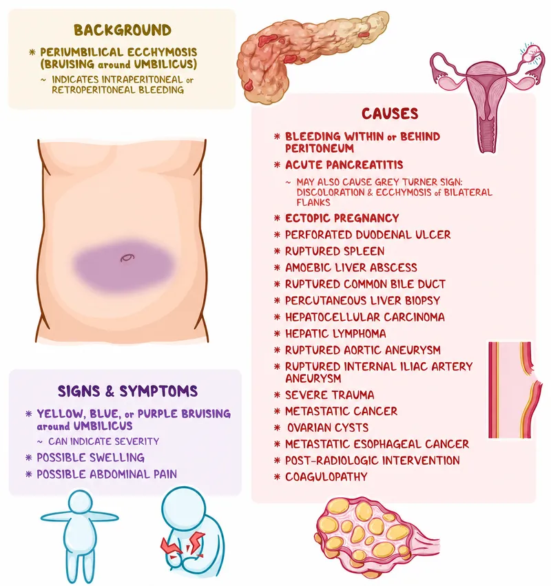 Cullen's sign in acute pancreatitis