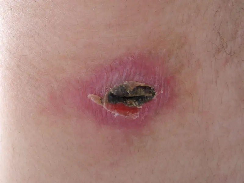 Classic eschar of Scrub Typhus