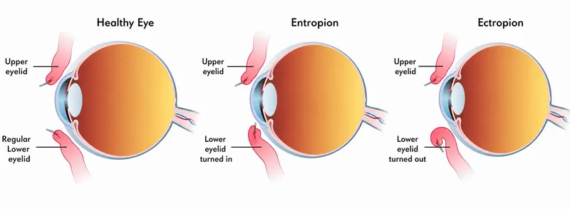 Entropion and Ectropion Diagram