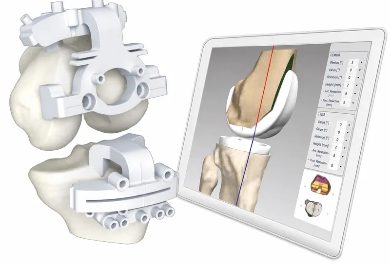 Patient-specific instrumentation guides for knee replacement