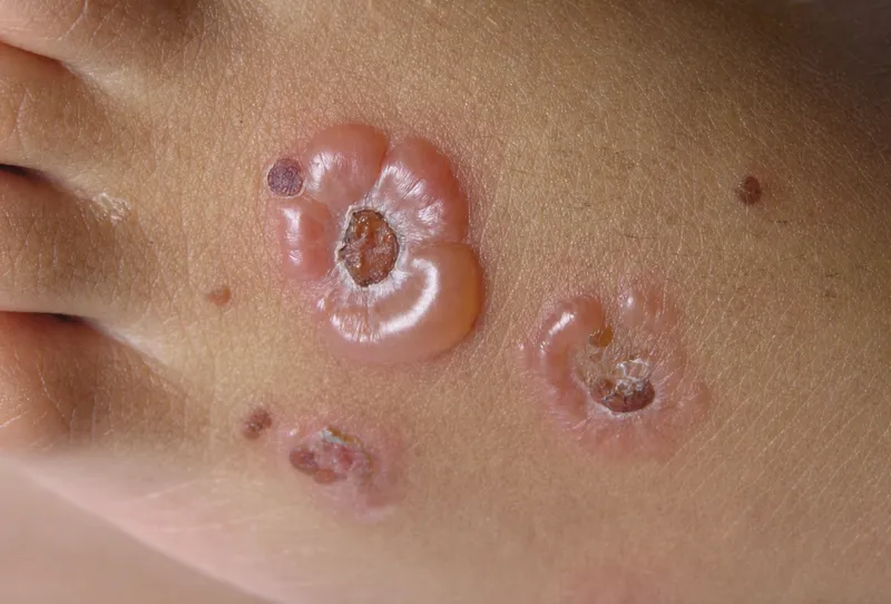 Linear IgA Bullous Dermatosis "String of Pearls"