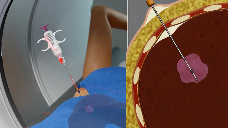 CT-guided core needle biopsy of a liver lesion