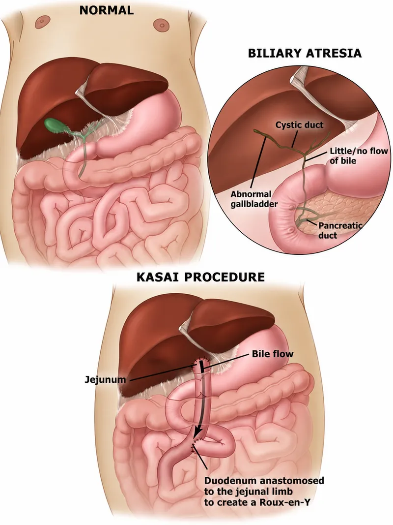 Biliary Atresia and Kasai Procedure