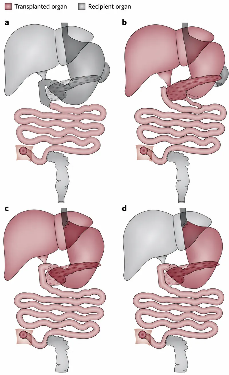 Small bowel transplant graft types and anastomoses