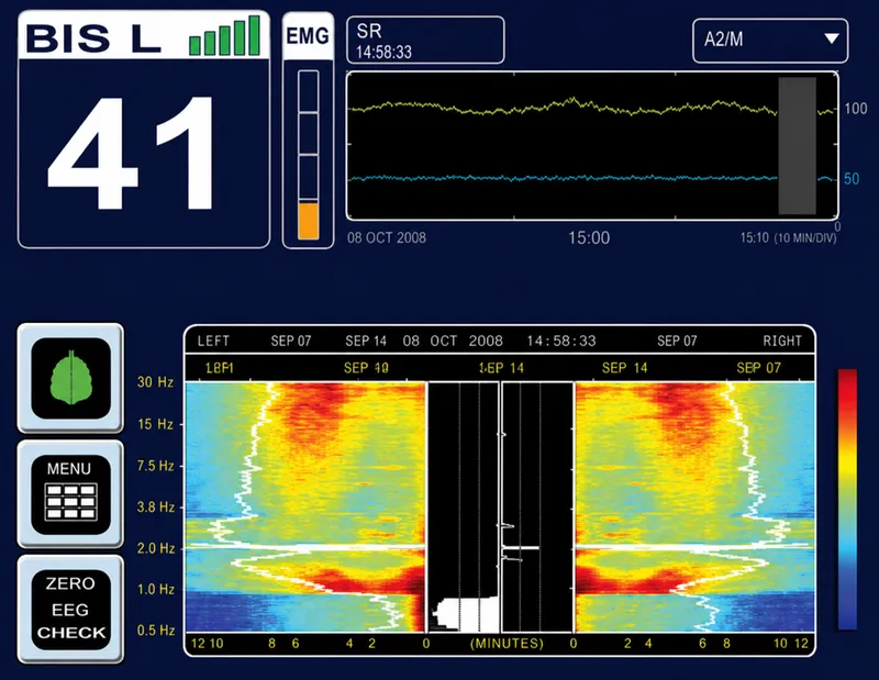 BIS monitor display showing processed EEG waveforms and numeric values