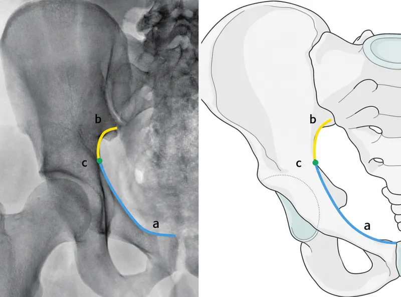 Pelvic anatomy with iliopectineal and ilioischial lines
