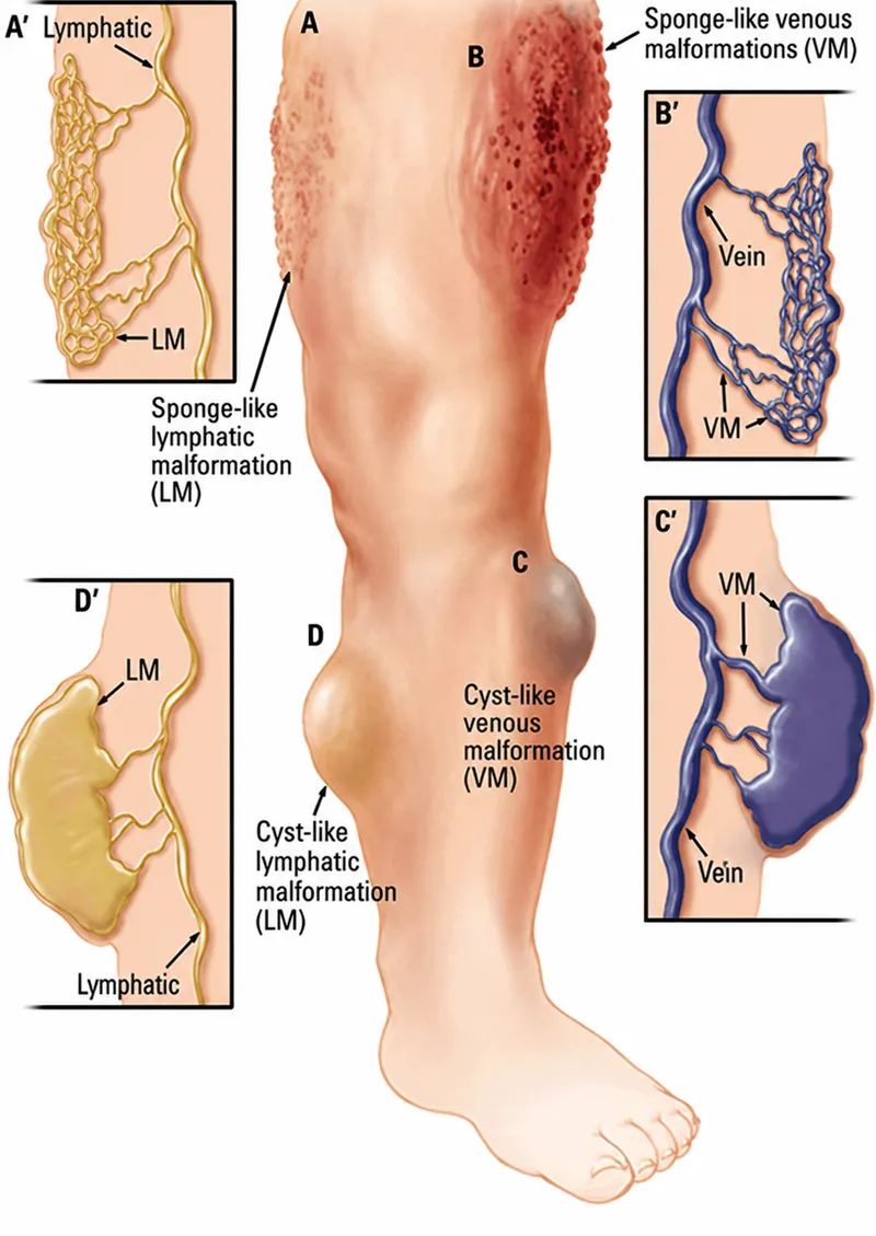 Types of vascular malformations