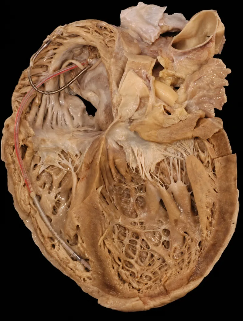 Comprehensive cardiac pathology specimen showing various disease states