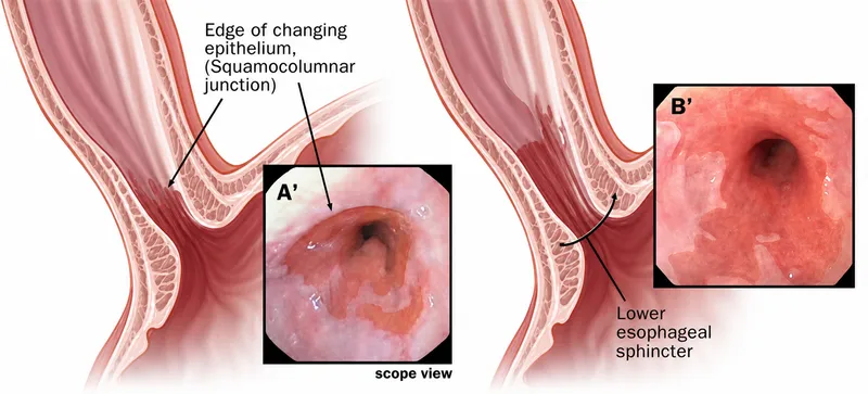 Figure 1: Endoscopy showing salmon-pink columnar epithelium extending above gastro-oesophageal junction
