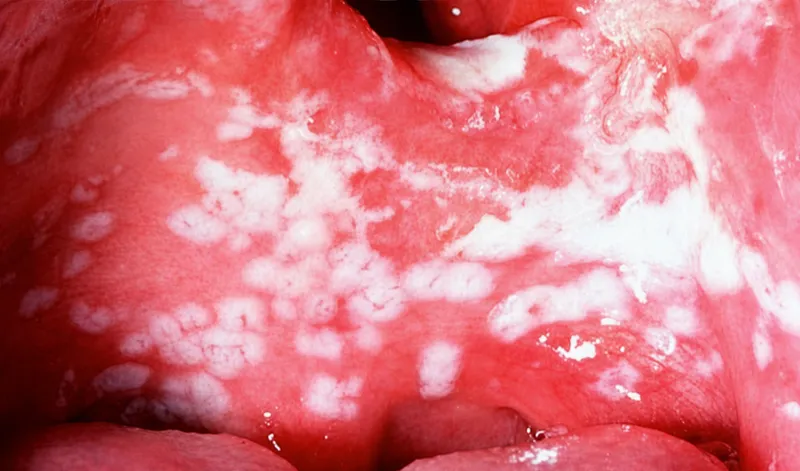 Oropharyngeal candidiasis (thrush)