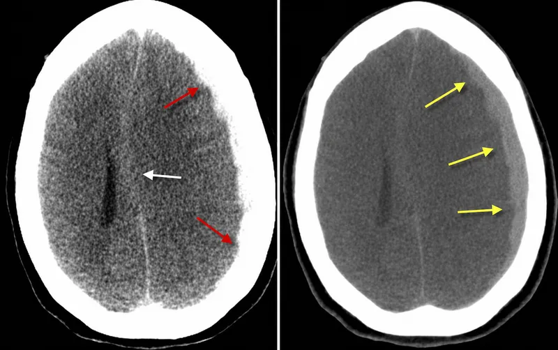 CT scan showing acute and chronic subdural hematoma